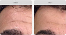 Load image into Gallery viewer, BOOK NOW! Skin Needling Promotion - BUY 5, RECEIVE 6 TREATMENTS