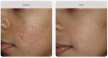 Load image into Gallery viewer, BOOK NOW! Skin Needling Promotion - BUY 5, RECEIVE 6 TREATMENTS