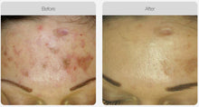 Load image into Gallery viewer, BOOK NOW! Skin Needling Promotion - BUY 5, RECEIVE 6 TREATMENTS