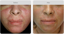 Load image into Gallery viewer, BOOK NOW! Skin Needling Promotion - BUY 5, RECEIVE 6 TREATMENTS