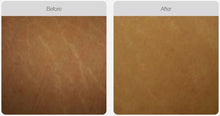 Load image into Gallery viewer, BOOK NOW! Skin Needling Promotion - BUY 5, RECEIVE 6 TREATMENTS