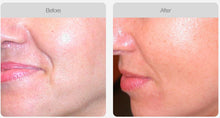 Load image into Gallery viewer, BOOK NOW! Skin Needling Promotion - BUY 5, RECEIVE 6 TREATMENTS