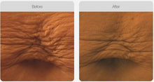 Load image into Gallery viewer, BOOK NOW! Skin Needling Promotion - BUY 5, RECEIVE 6 TREATMENTS
