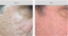 Load image into Gallery viewer, BOOK NOW! Skin Needling Promotion - BUY 5, RECEIVE 6 TREATMENTS