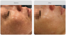 Load image into Gallery viewer, BOOK NOW! Skin Needling Promotion - BUY 4, RECEIVE 6 TREATMENTS (PRICE INCREASING 01 MARCH 2024)
