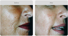 Load image into Gallery viewer, BOOK NOW! Skin Needling Promotion - BUY 4, RECEIVE 6 TREATMENTS (PRICE INCREASING 01 MARCH 2024)
